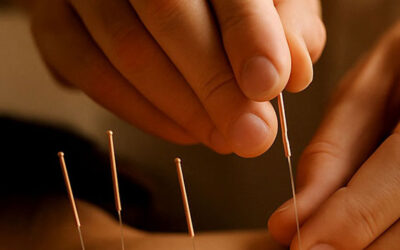 Acupuncture